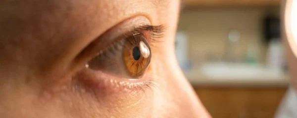 Gros plan sur l'œil d'une personne adulte dont la cornée présente une déformation conique caractéristique du kératocône, fond lumineux médical doux